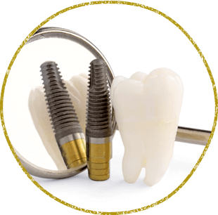 06 インプラント